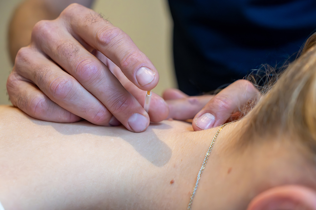 Dryneedling